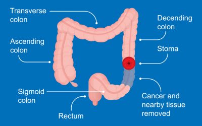 Understanding Colon Cancer Screening