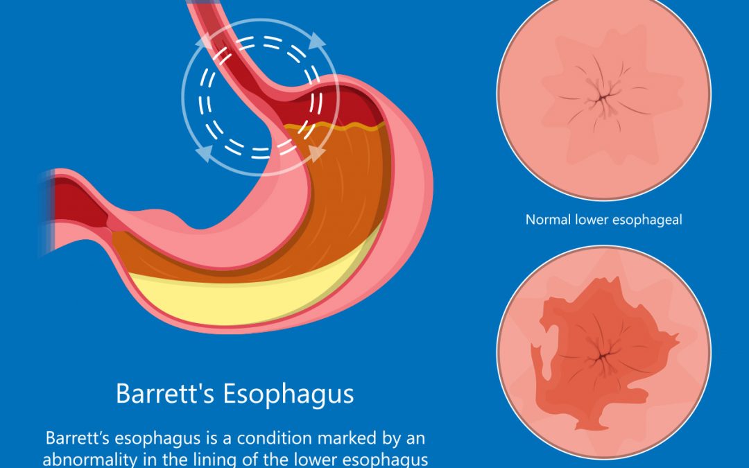 Understanding Barrett’s Esophagus